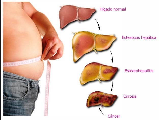 Etapas relacionadas con la salud del hígado